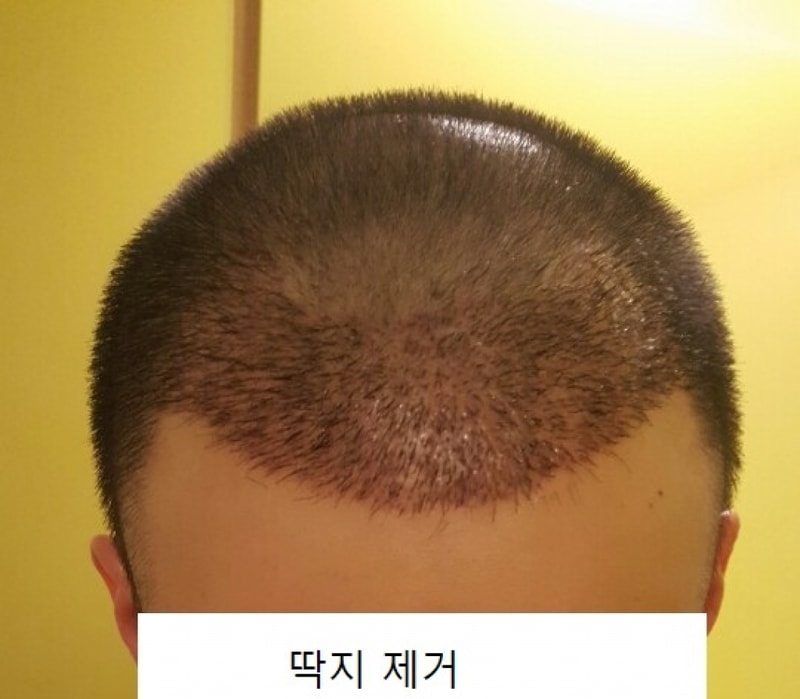 딱지 제거 후.jpg