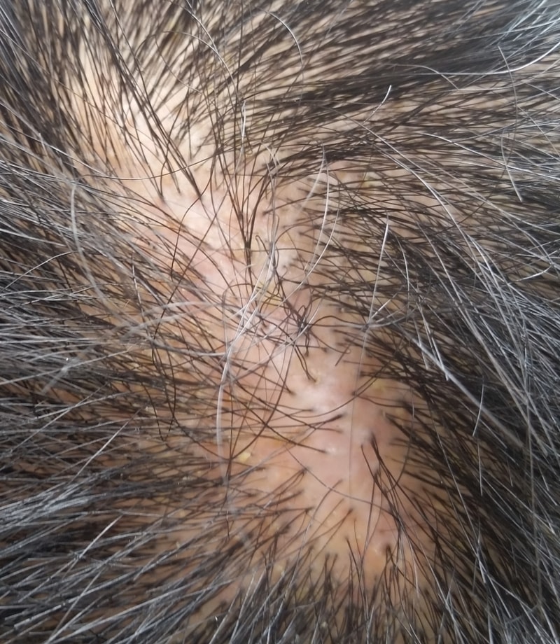 Back wound.jpg