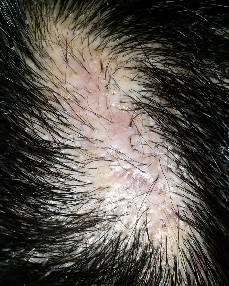 Back scar.jpg