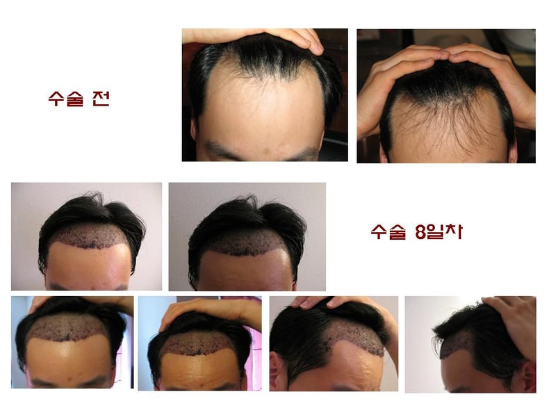 수술전후.jpg