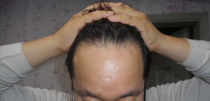 비절개 3000모 수술 후기 (1년 8개월 경과)