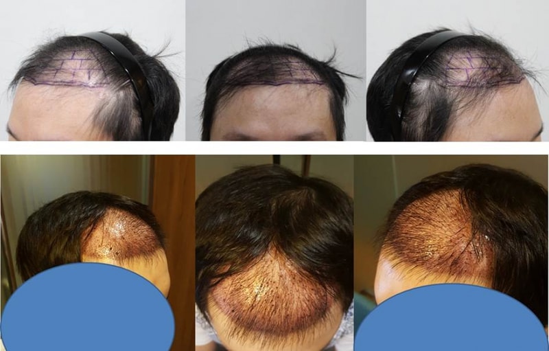 수술전 & 수술후 3일.jpg