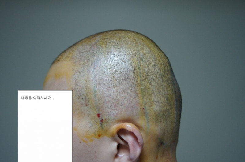 5 2차 수술전.JPG