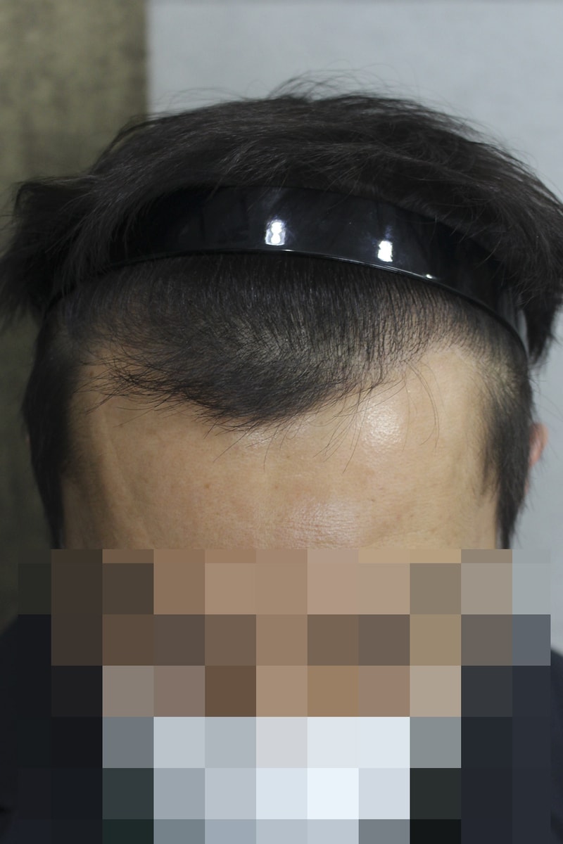 M자 이식하고 9개월을 향해 열심히 가는 중입니다