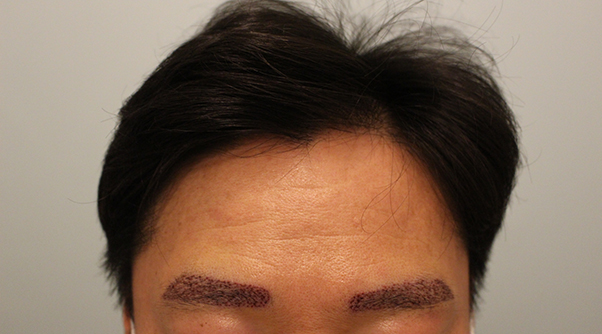 수술후 1일 3.JPG