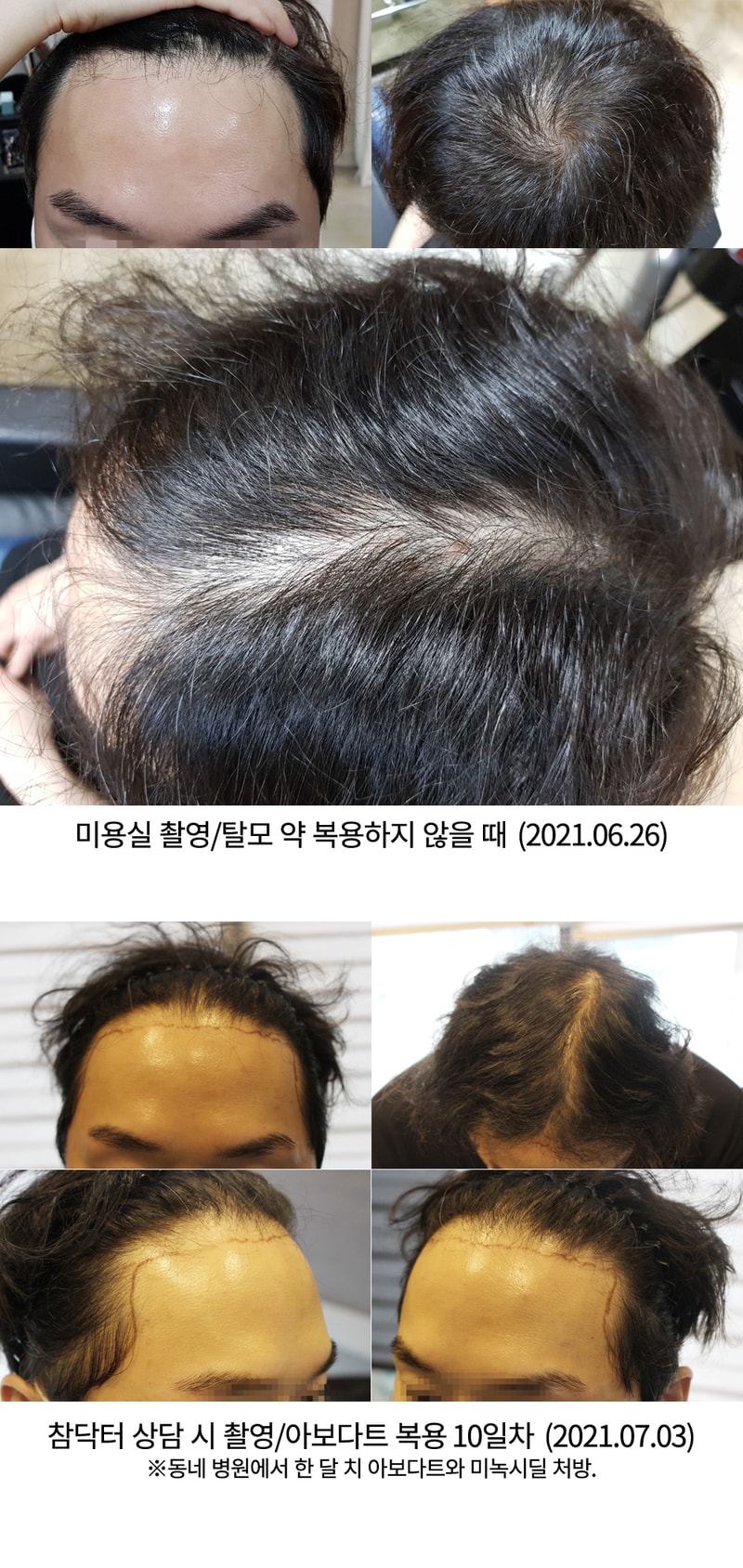 모발 이식 과정 기록 [참닥터/M자&정수리/절개&비절개(복합)/5,500모] ※ 계속 수정/업뎃