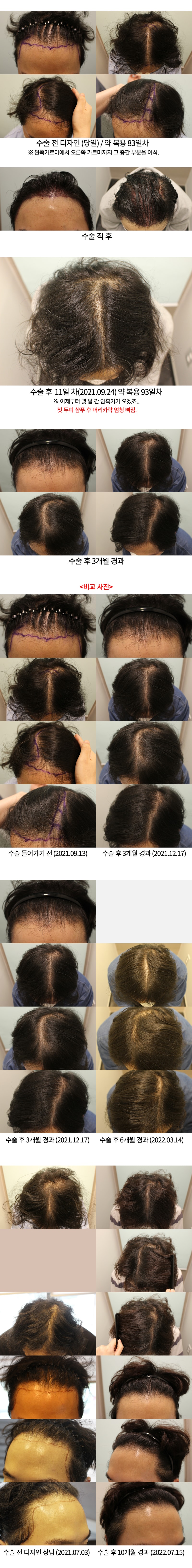3_수술후 10달.jpg