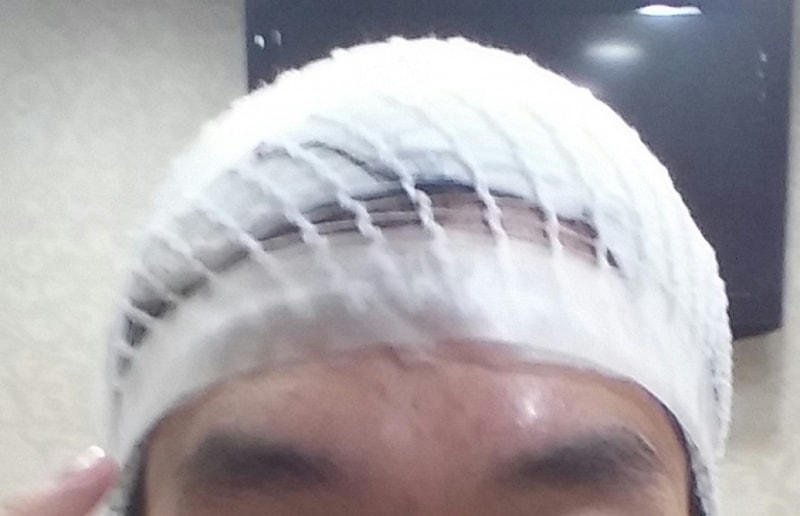 이식 직후.jpg