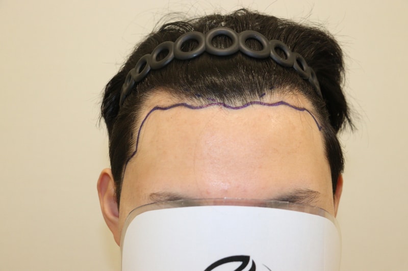 a review of hair transplantation