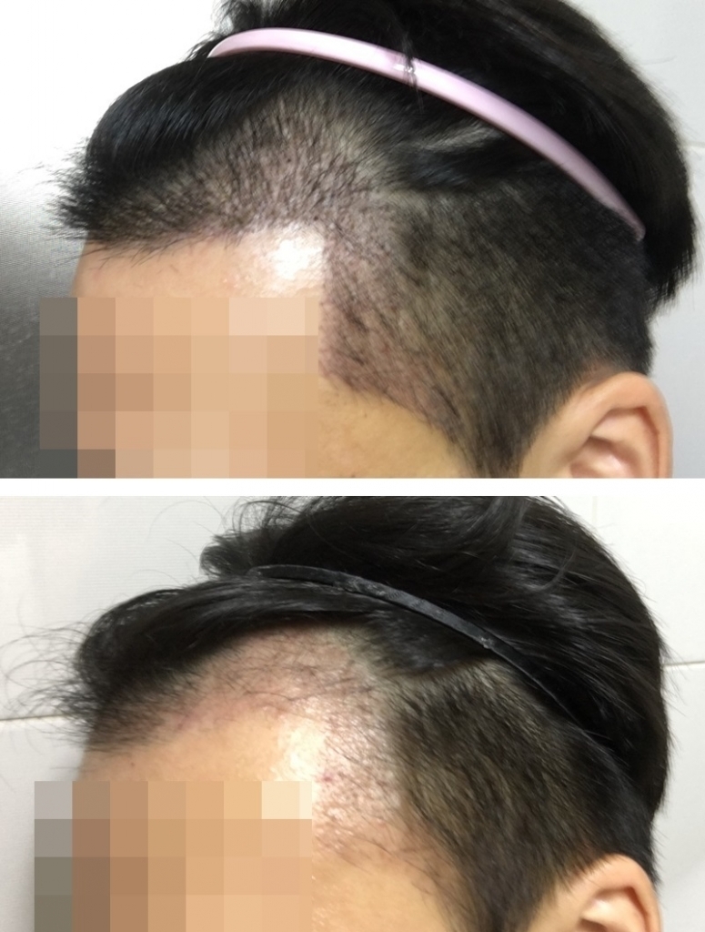 절개 이식 1개월차 암흑기 제대로 왔습니다 대부분이 사라지고 휑함