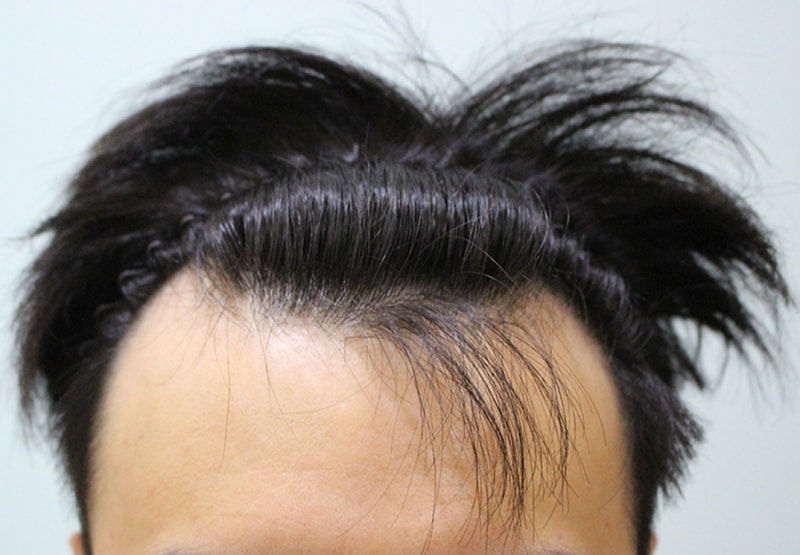 수술전 (2).JPG