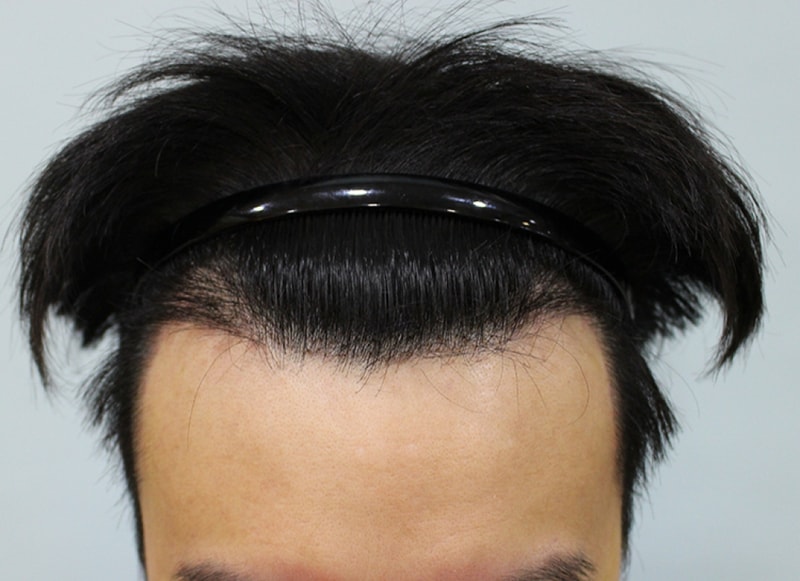 수술후 9일 (9).JPG