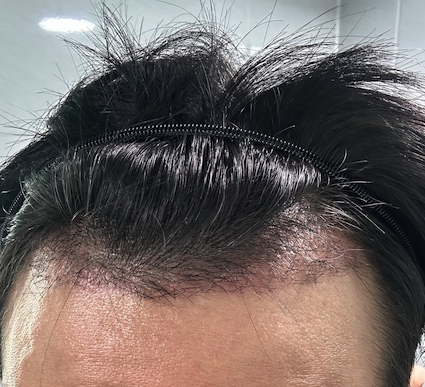 移植後ひと月体験談