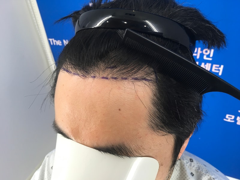 1차 부산에서 수술 후 2차 보강 노블라인에서 받고 졸업했습니다.