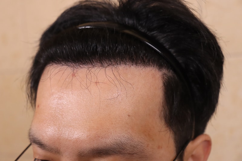  3300모 비절개 모발 이식 8개월 차 후기 남깁니다. 