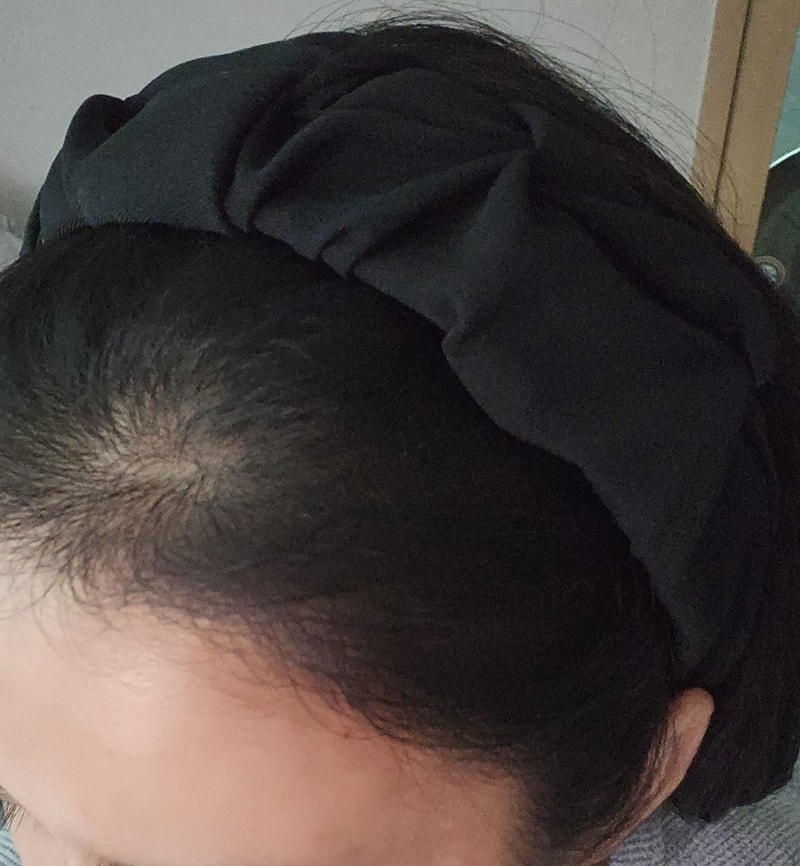 4. 수술후_6개월_셀카_2.jpg