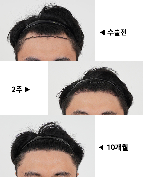울산모발이식, 모모 부산점 1500모 11개월 완성 후기