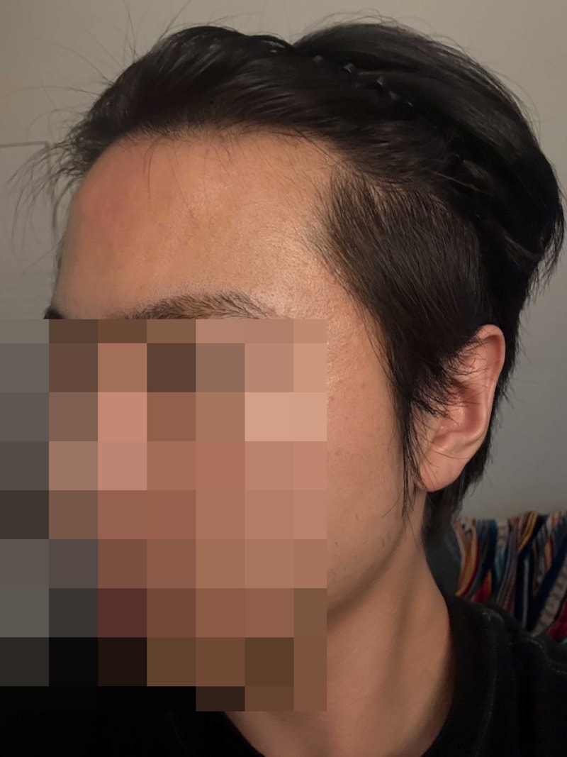 다나성형외과 유승현원장님 추천 / 무삭발비절개 16개월 / 2000모