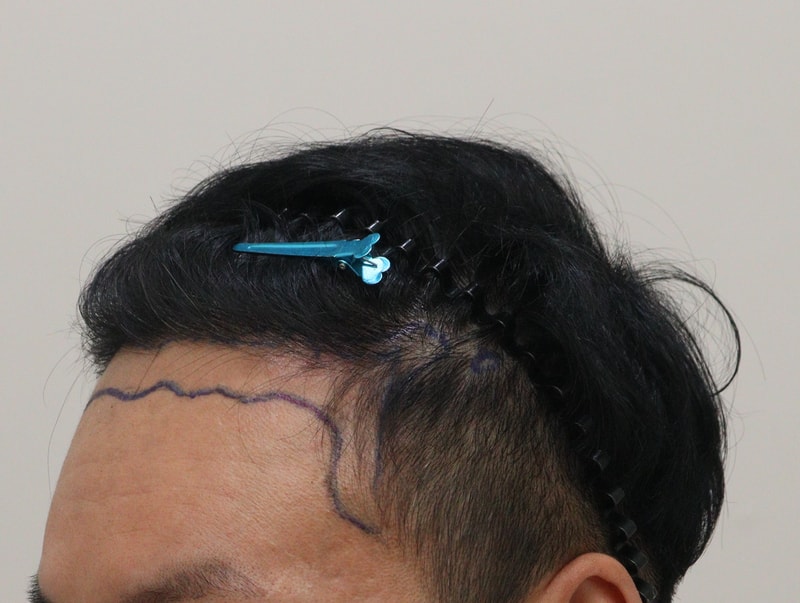 1. 수술전_2.JPG
