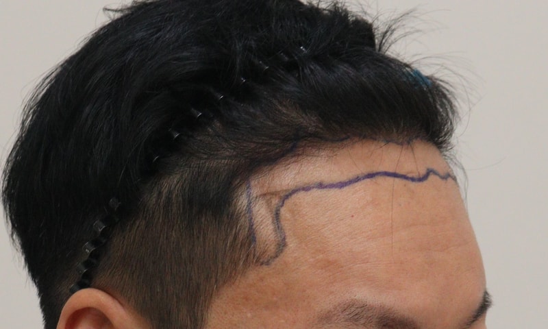 1. 수술전_3.JPG