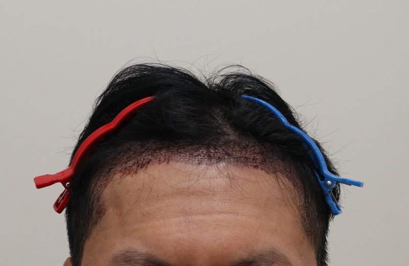 2. 수술후_1일_1.JPG