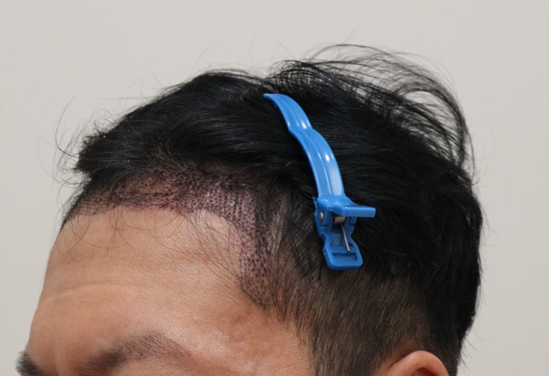 2. 수술후_1일_2.JPG