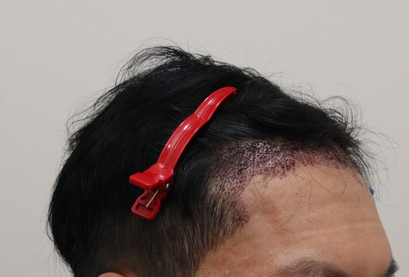 2. 수술후_1일_3.JPG