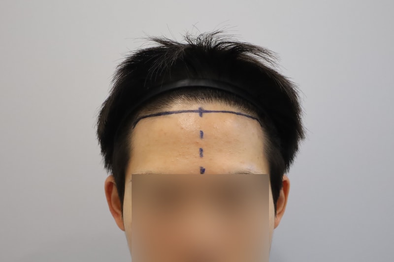 M자 헤어라인 비절개 모발이식 4개월 모원성형외과