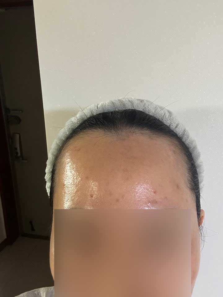 Head Park Jong-ok of the 2nd week of hairline 1500 hair follicle non-cut Hair Transplant MO.1 plastic surgery