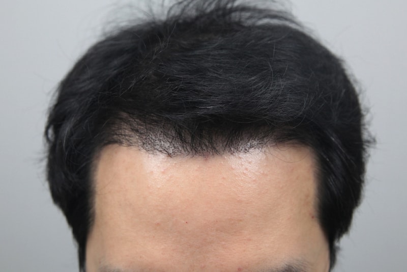 Monara 4400 hair transplant → Design → 1 month → 4 months change