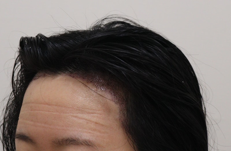 2. 수술후_1일_2.JPG