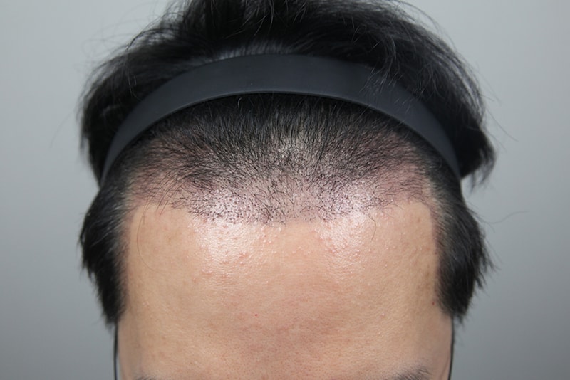 모나라모발이식_4400모경과 (3).jpg