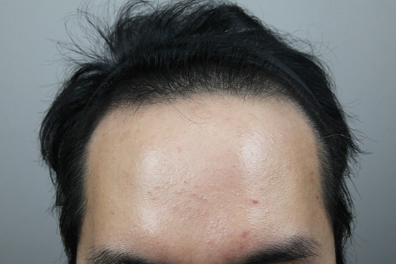 모나라모발이식_4400모경과-(1).jpg
