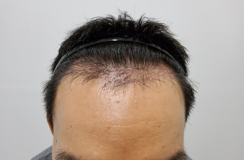 3. 수술후_3개월_1.jpg