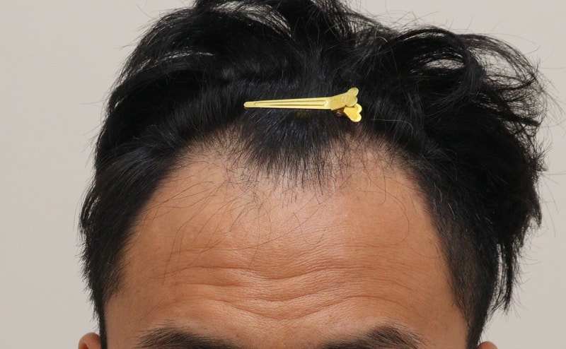 1. 수술전_1.JPG