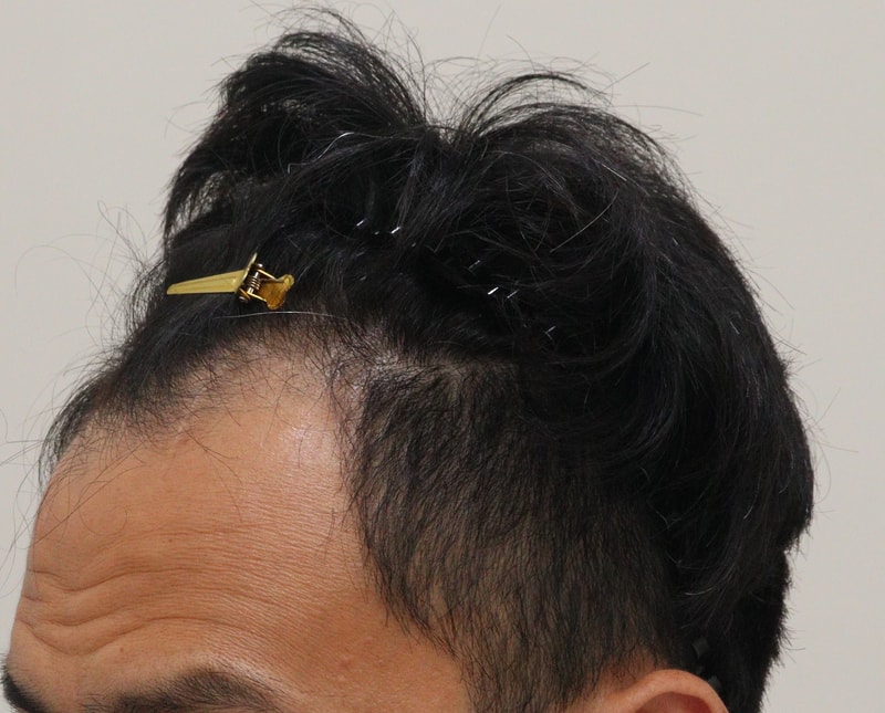 1. 수술전_2.JPG