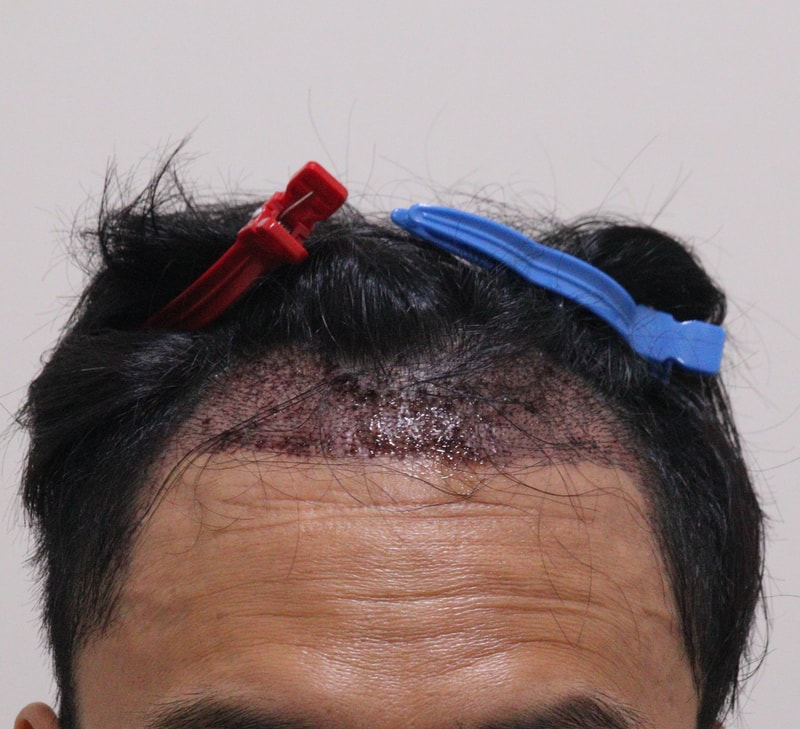 2. 수술후_1일_1.JPG