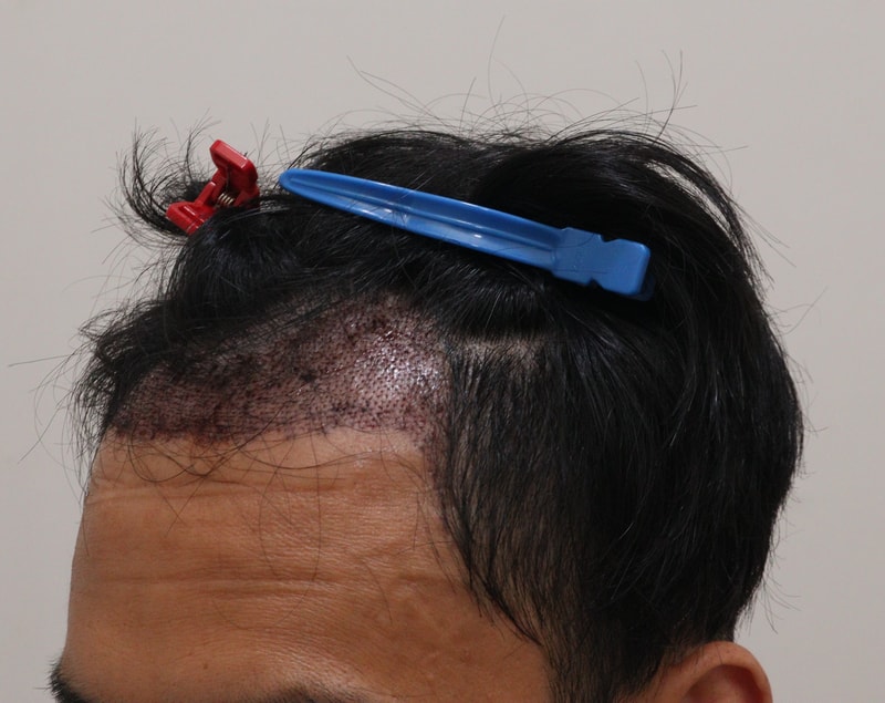 2. 수술후_1일_2.JPG