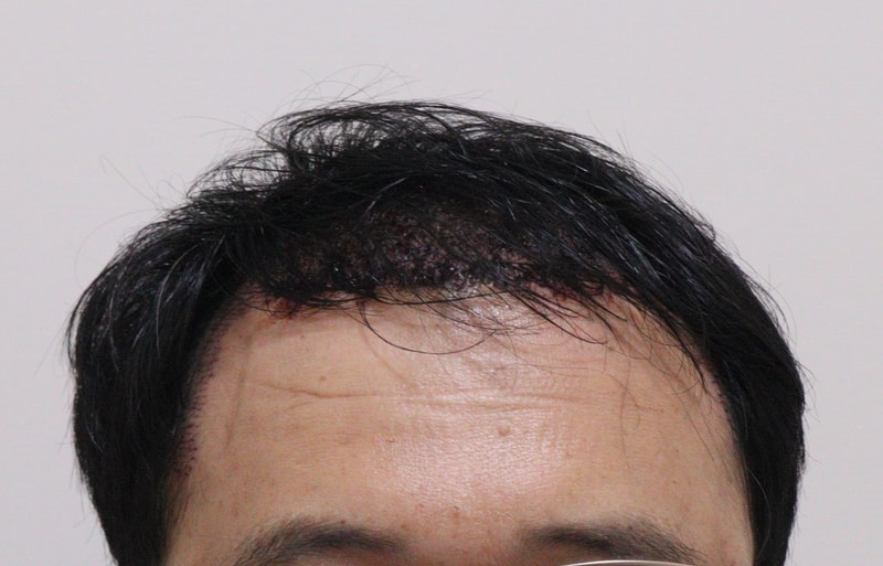2. 수술후_1일_1.JPG