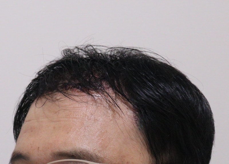 2. 수술후_1일_2.JPG