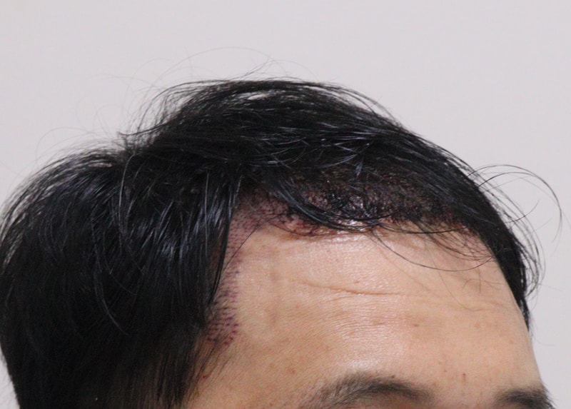 2. 수술후_1일_3.JPG