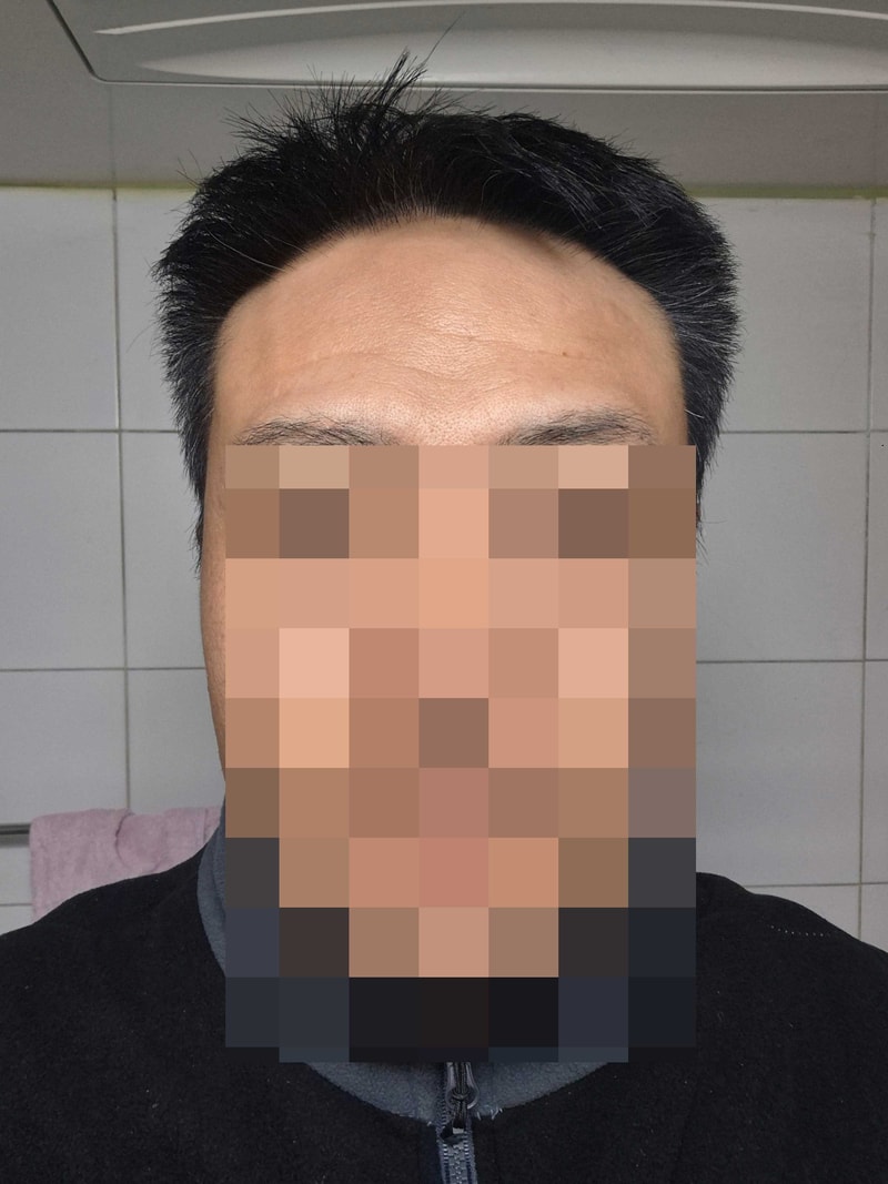 모발이식16개월차.jpg