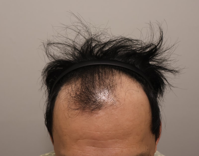 모발이식 3개월차 후기