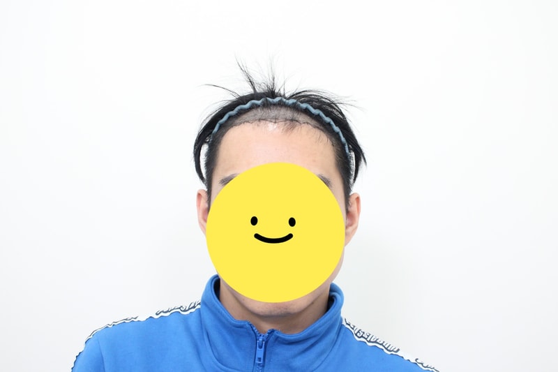 Let's hear about the two-week review of men's non-cut Hair Transplant!