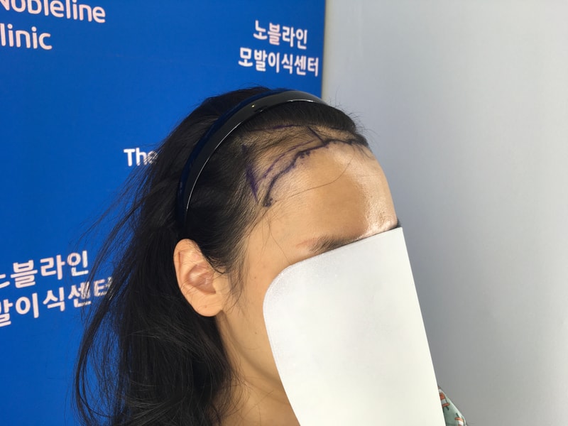 여자 헤어라인 4개월차에요.
