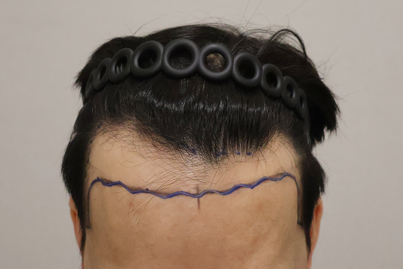 동탄헤어로의원 4500모 9개월 후기