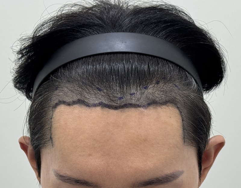 박상현 원장님 비절개 2000모