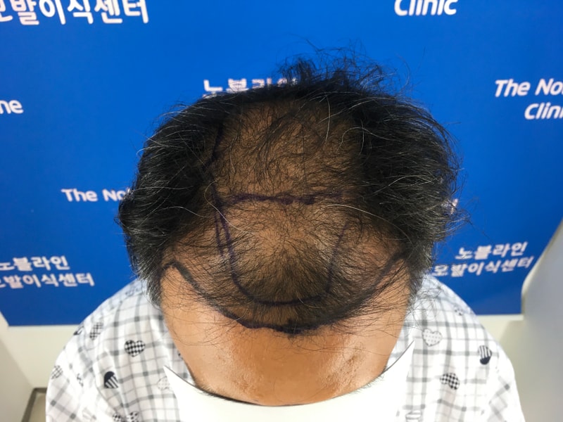대량모발이식 아직 4개월 입니다.