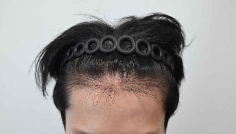 모엠의원 모발이식 9개월 경과 후기