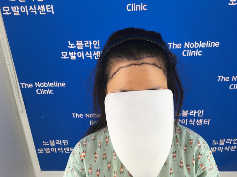 헤어라인하고 만족스러운 4개월 입니다!